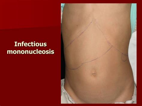 After a while, white patches can appear on your tonsils (exudative. PPT - Infectious diseases with tonsillitis. Diphtheria ...