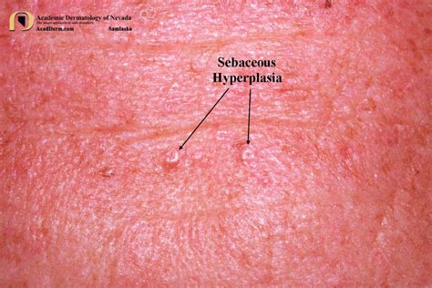 Sebaceous Hyperplasia Chin