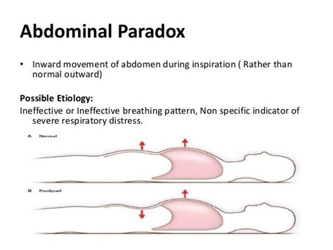Image Result For Abdominal Paradoxical Breathing Paradox Abdominal