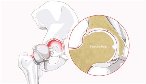 Hip Labrum Repair And Reconstruction FAI Orthopedic Hip Surgeon Manhattan New York NY