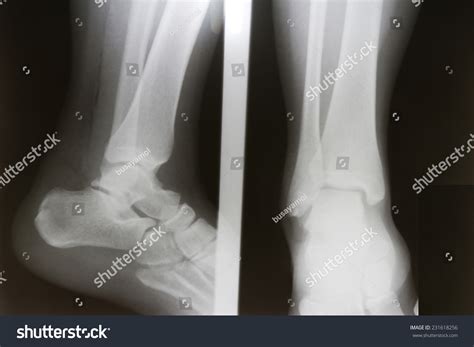 Film Xray Ankle Aplateral Show Fracture Stock Photo 231618256