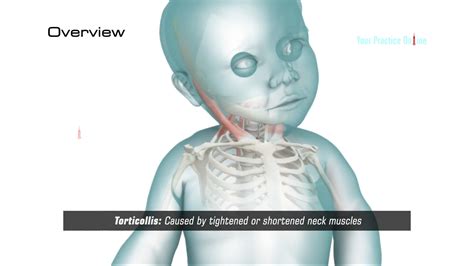 Torticollis Video Medical Video Library