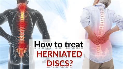 How To Get Rid Of Herniated Disc Without Surgery Best Treatments Youtube