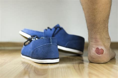 How To Treat And Prevent Foot Blisters Hubert Lee Dpm Podiatrist