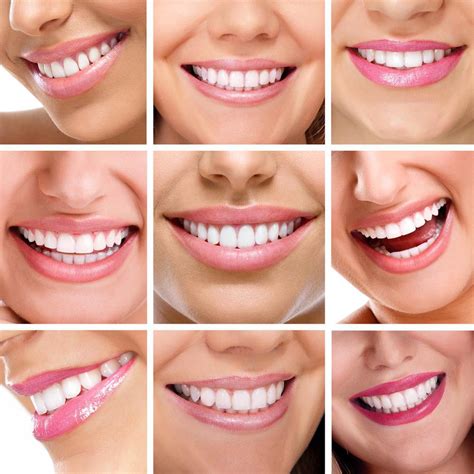 Diferenças entre coroas dentárias e folheados Scott babe DDS Odontologia Cosmética geral e
