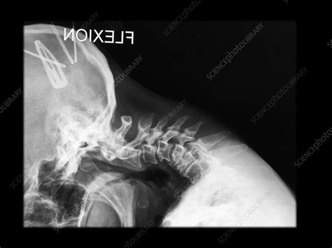 X Ray Of Severe Degenerative Changes Cervical Spine Stock Image