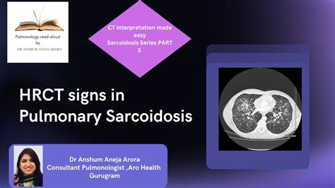 Decoding CT Scan Findings In Sarcoidosis Of Lung YouTube