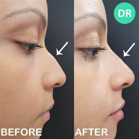 Bump On Nose Treatment Without Surgery Dr Aesthetica