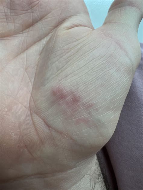 I Have Some Red Raised Bumps On My Palm They Are Dry And Not Itchy
