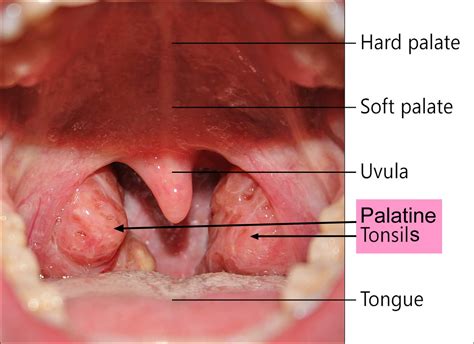 Peritonsillar Abscess Causes Signs Symptoms Diagnosis And Treatment