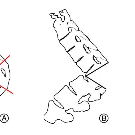 Diagram Of The Dcvo Technique A A Wider Wedge Shaped Osteotomy Was