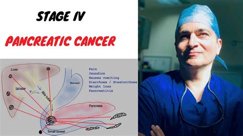 Pancreatic Cancer Stage 4 Youtube