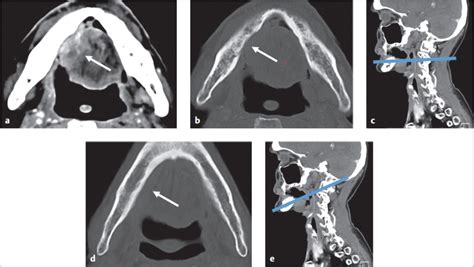 7 Imaging Of Oral Cavity Cancers Pocket Dentistry