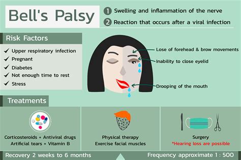 Bell S Palsy Eye Patient