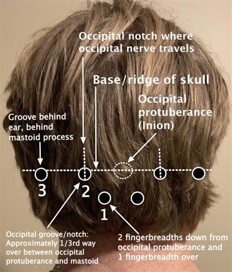 What A Pain In The Back Of The Head Occipital Neuralgia Treatments