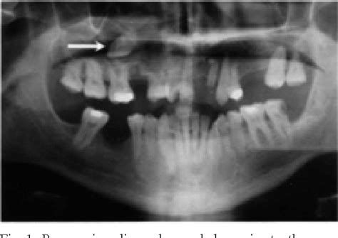 Figure 1 From A Dentigerous Cyst Containing An Ectopic Canine Tooth
