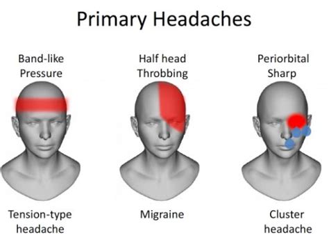Diagnose Headache Types From Headache Chart To Treat Headache
