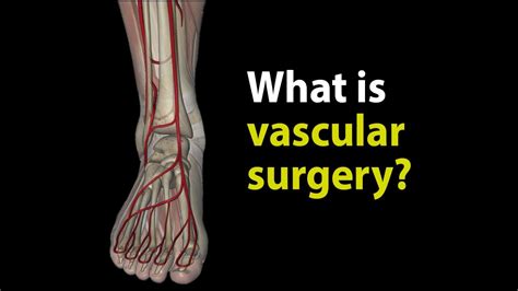 What Is Vascular Surgery Youtube