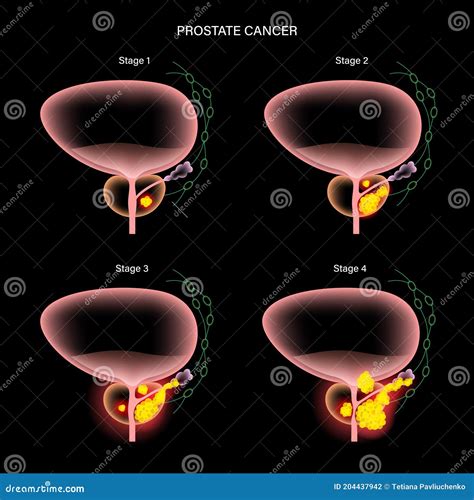 Prostate Cancer Concept Stock Vector Illustration Of Carcinoma