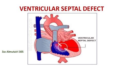 Ventricular Septal Defect Diagram