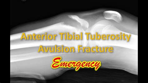 Anterior Tibial Tuberosity Avulsion Fracture Emergency Youtube