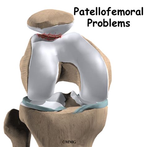 How to ease knee pain and swelling. Patellofemoral Problems | Orthogate