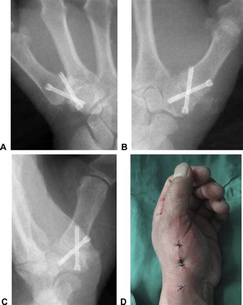 Minimally Invasive Thumb Carpometacarpal Joint Arthrodesis With