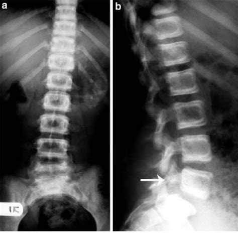 Anteroposterior Ap A And Lateral B Radiographs Of The Lumbar Spine