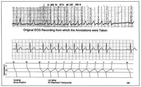 Validation Of The Einthoven Model Based Computerized Electrocardiogram