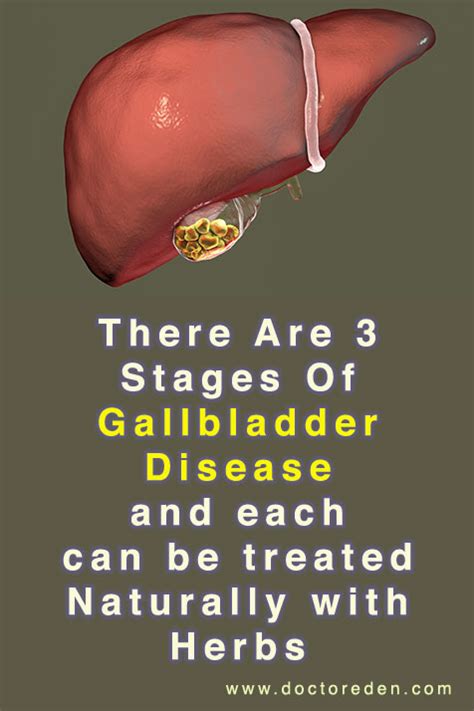 Gallbladder Treatment Stages Of Gallbladder Disease And How To Avoid It