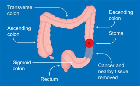 It is sometimes used with a dash after it. Understanding Colon Cancer Screening - Gastrointestinal ...