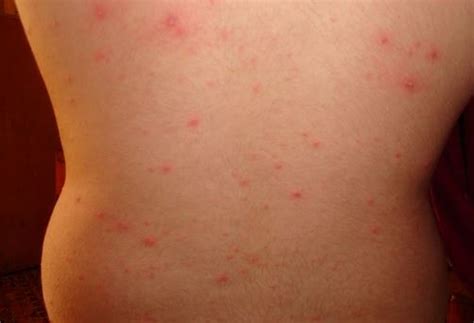Maculopapular Rash Pictures Causes Treatment