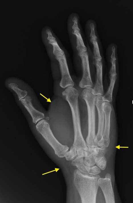 Cellulitis Hand Surgery Resource