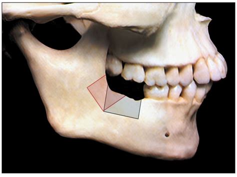 5 Harvesting Bone From The Ramus Pocket Dentistry