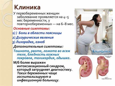 Пиелонефрит беременных диета Пиелонефрит беременных - online presentation Пиелонефрит беременных - online presentation Пиелонефрит беременных диета