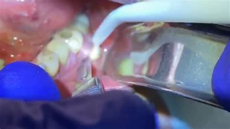 Draining A Dental Abscess Advanced Dental Care Youtube