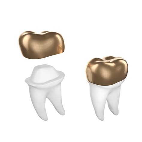 Gold Tooth Crowns Procedure Pros Cons And Costs