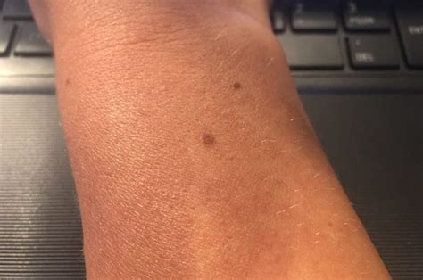 Is It A Myth Or Do All Women Have A Freckle On Their Wrist Y108