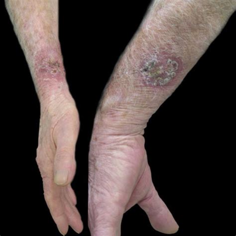 Sporotrichosis Cutaneous Form Of Multiple Inoculation In Both Forearms