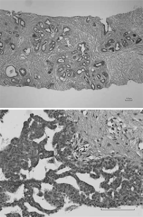 Figure 1 From A Case Of Phyllodes Tumor Of The Breast With Malignant