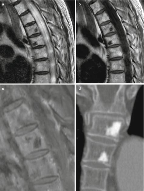 Common Spinal Tumors Outside The Top 3 Lists In Alphabetical Order