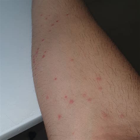 Bed Bug Bites In Australia A Step By Step Guide To Treat Rashes