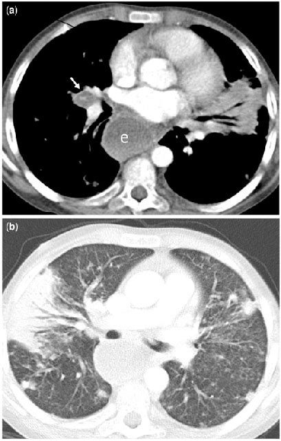 A Contrast Enhanced Ct Of The Chest Shows Enlarged Lymph Nodes In The