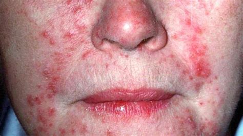 The Stages Of Rosacea