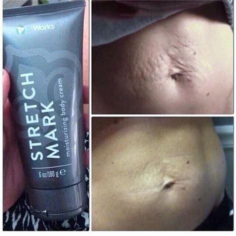 Laser Stretch Mark Removal Before And After African American