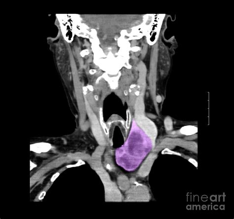 Ct Of Neck Showing Thyroid Goiter 1 Photograph By Medical Body Scans