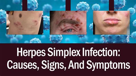 Herpes Simplex Infection Causes Signs And Symptoms Natural Herpestreatment Herpes Cure