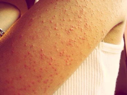 Ways To Get Rid Of Bumps On Arms Howhunter