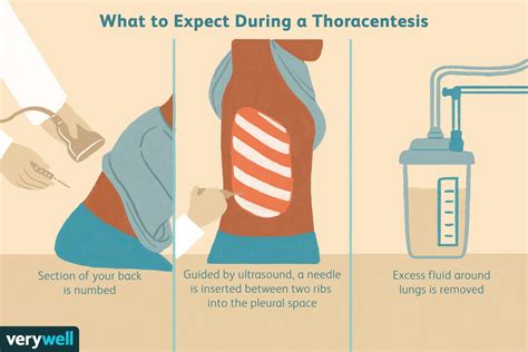 Thoracentesis Uses Procedure Complications Results