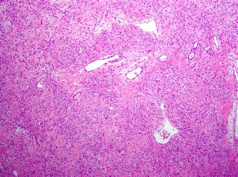 Pathology Outlines Sclerosing Stromal Tumor